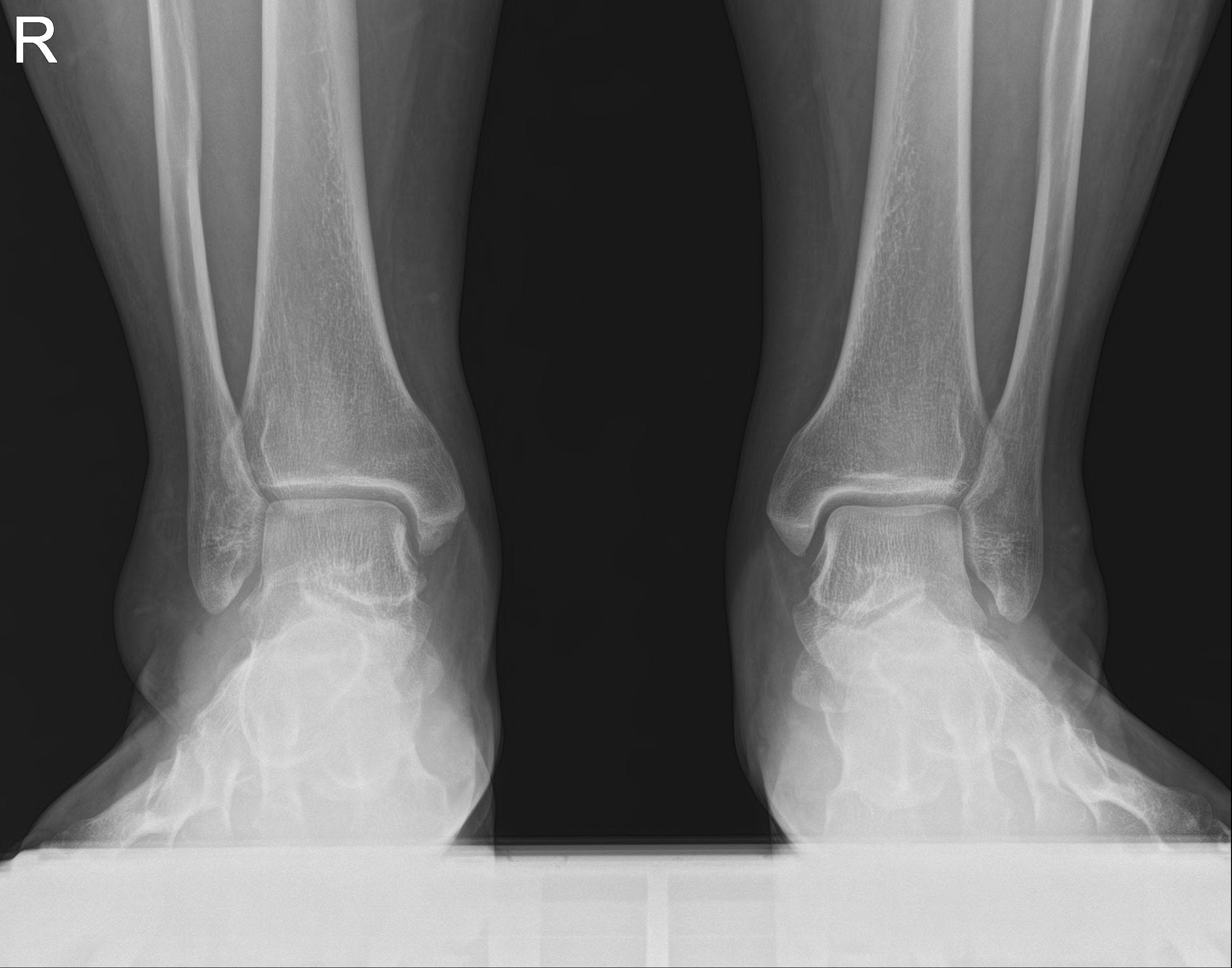 Ankle AP 원본