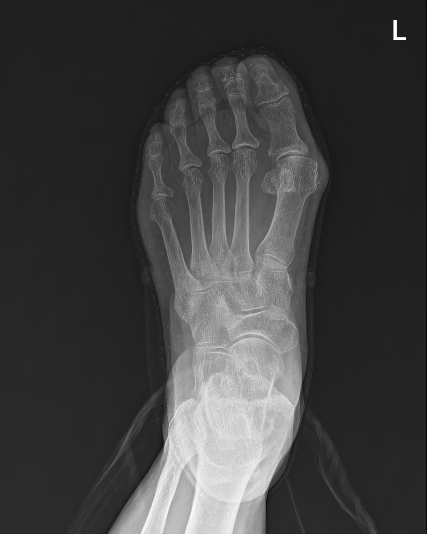 Foot AP 원본
