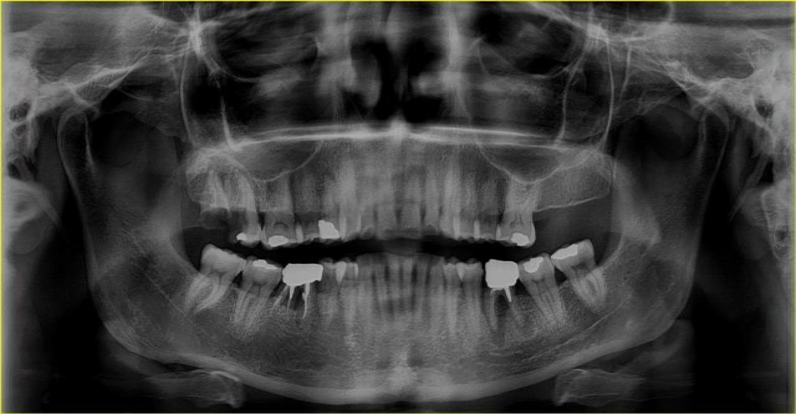 Tooth 원본