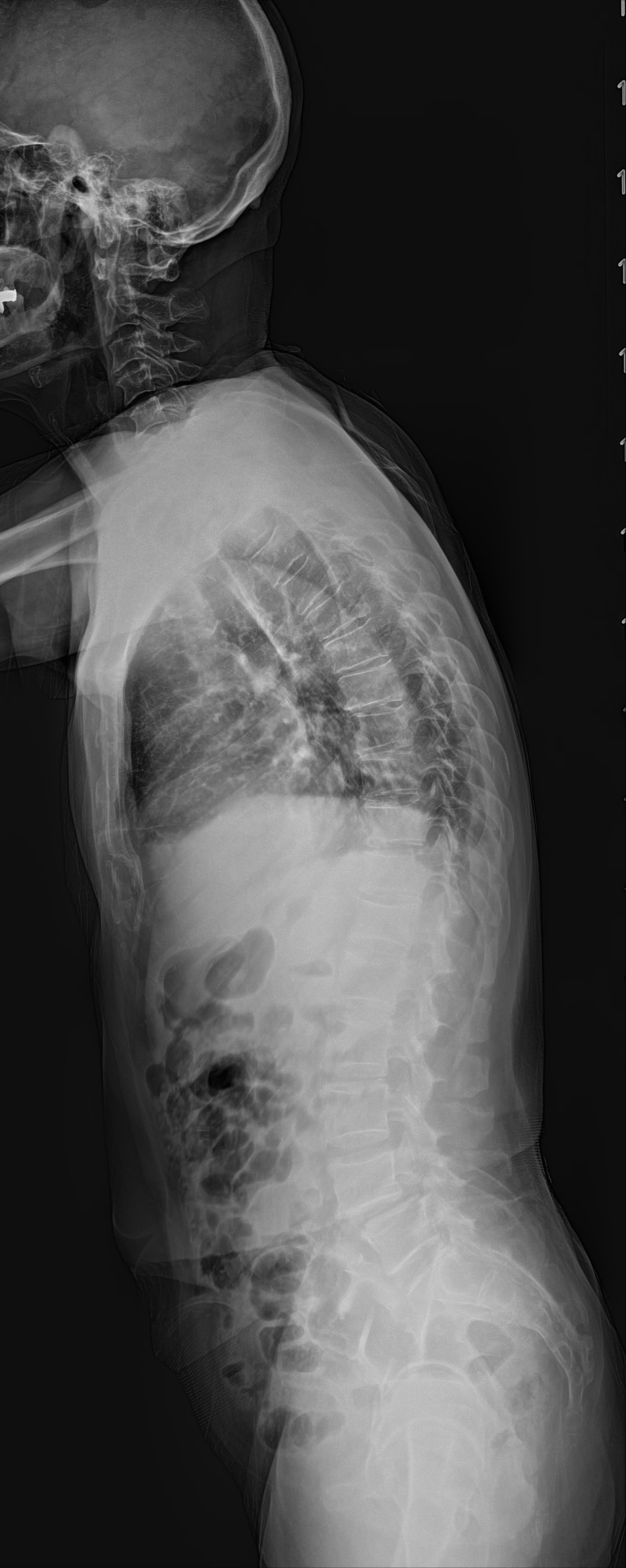 Whole Spine LAT 원본