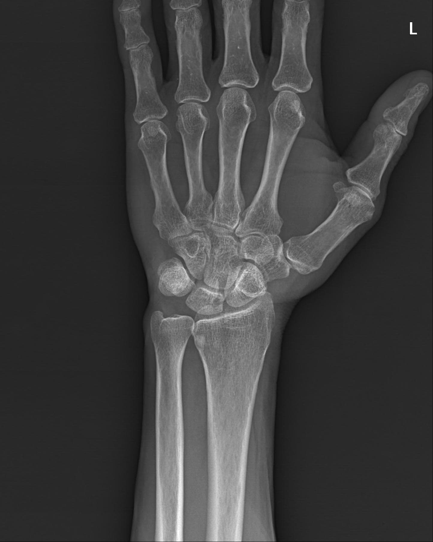 Wrist AP 원본
