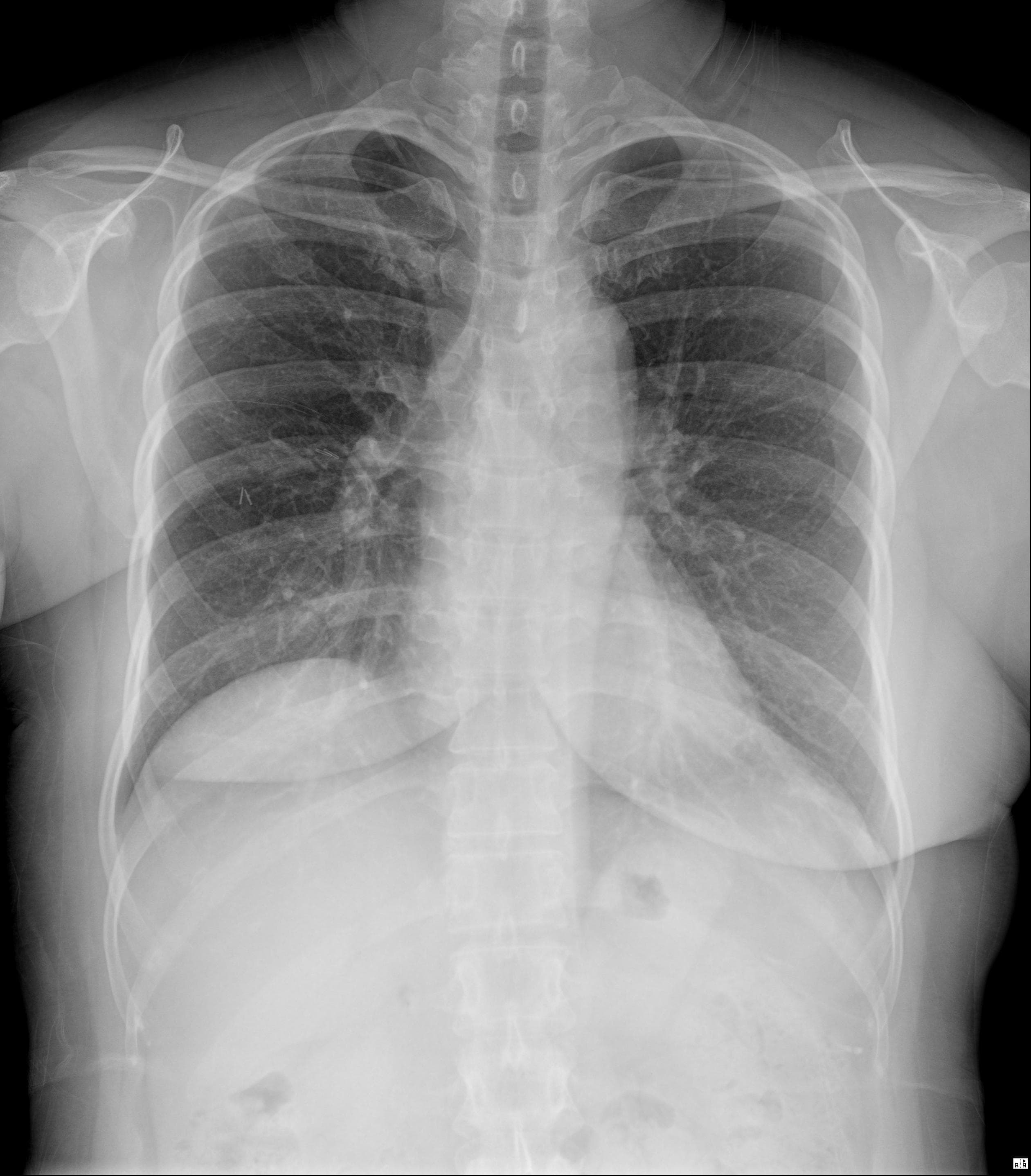 Chest 원본