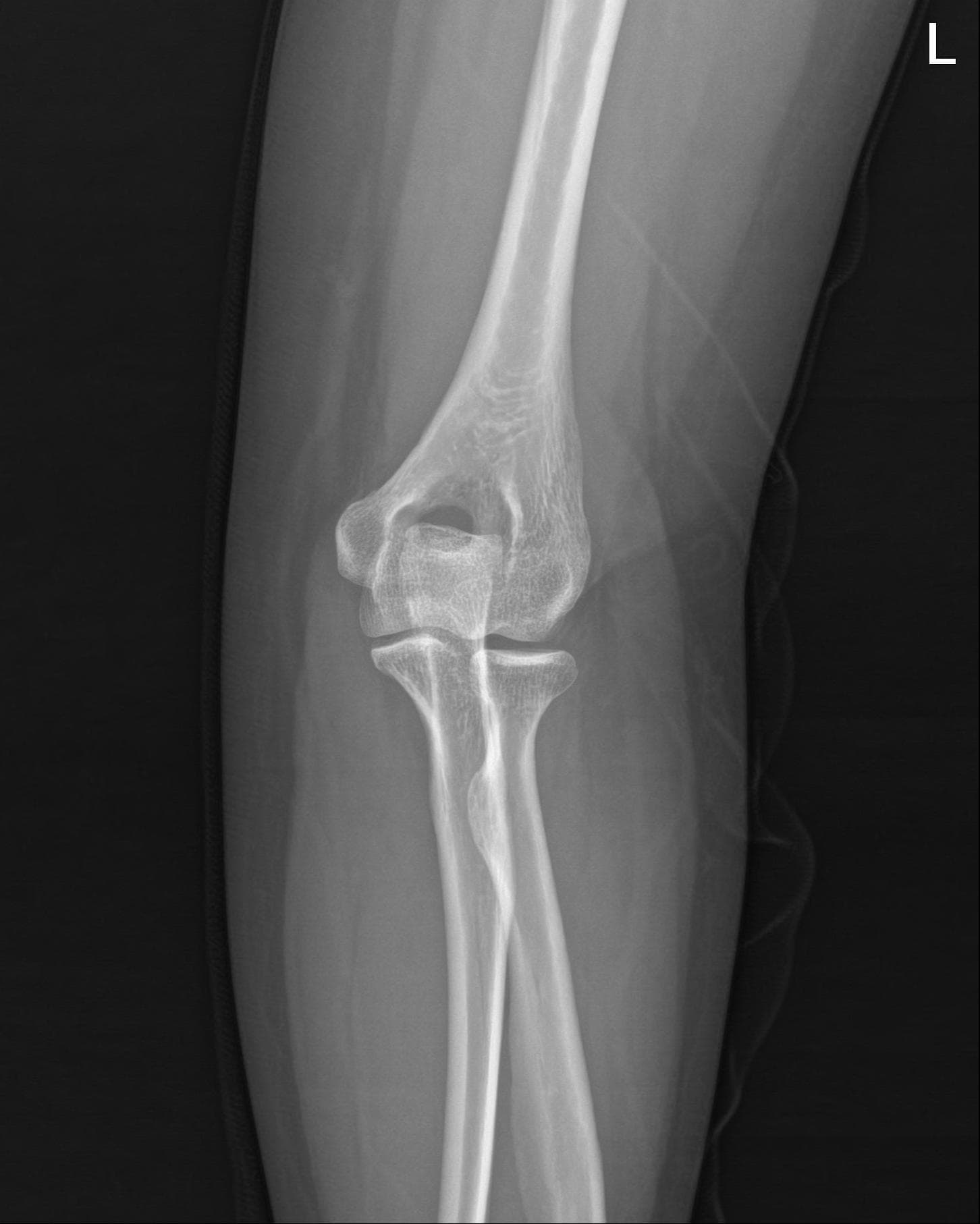 Elbow AP 원본
