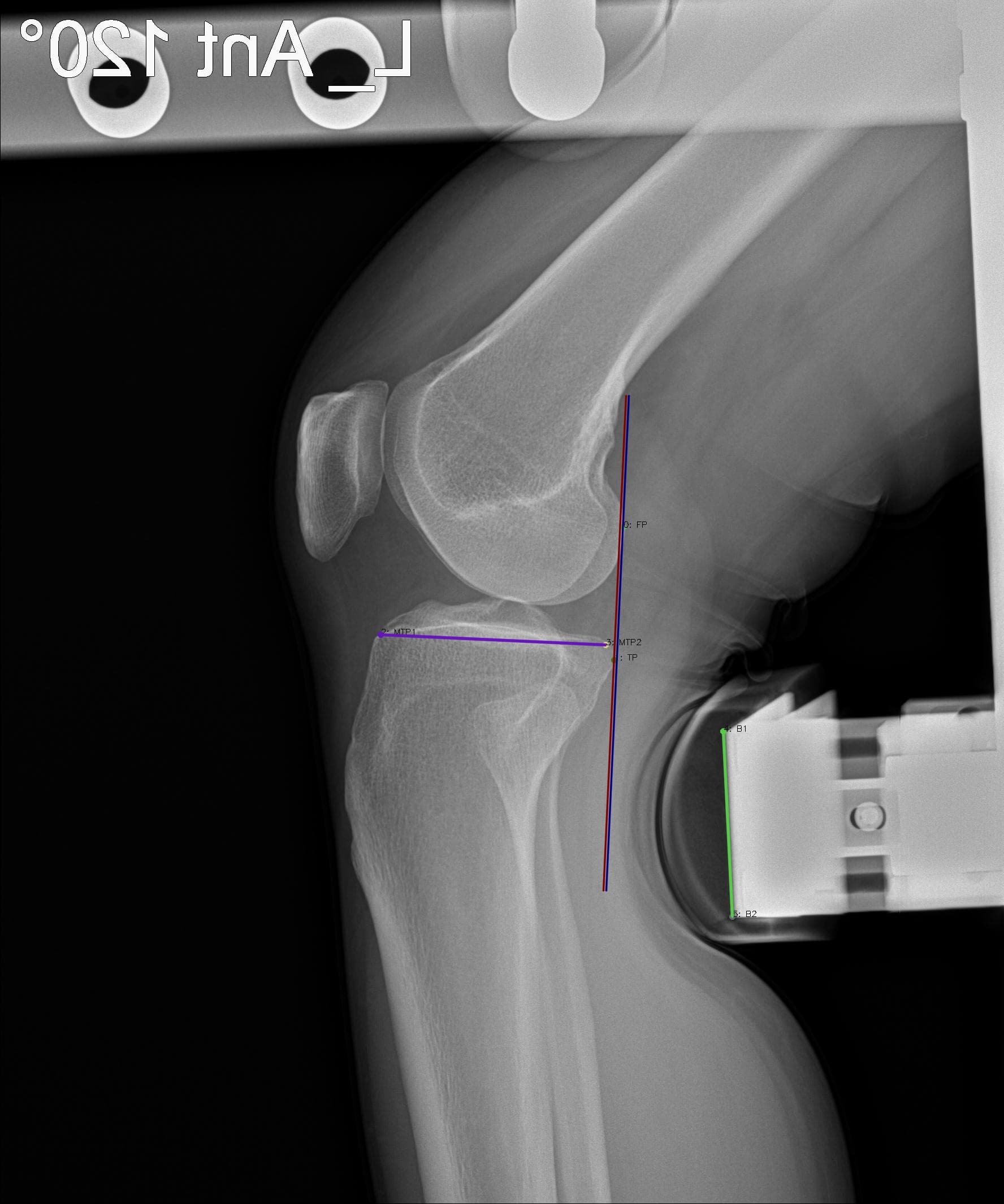 ACL/PCL 결과