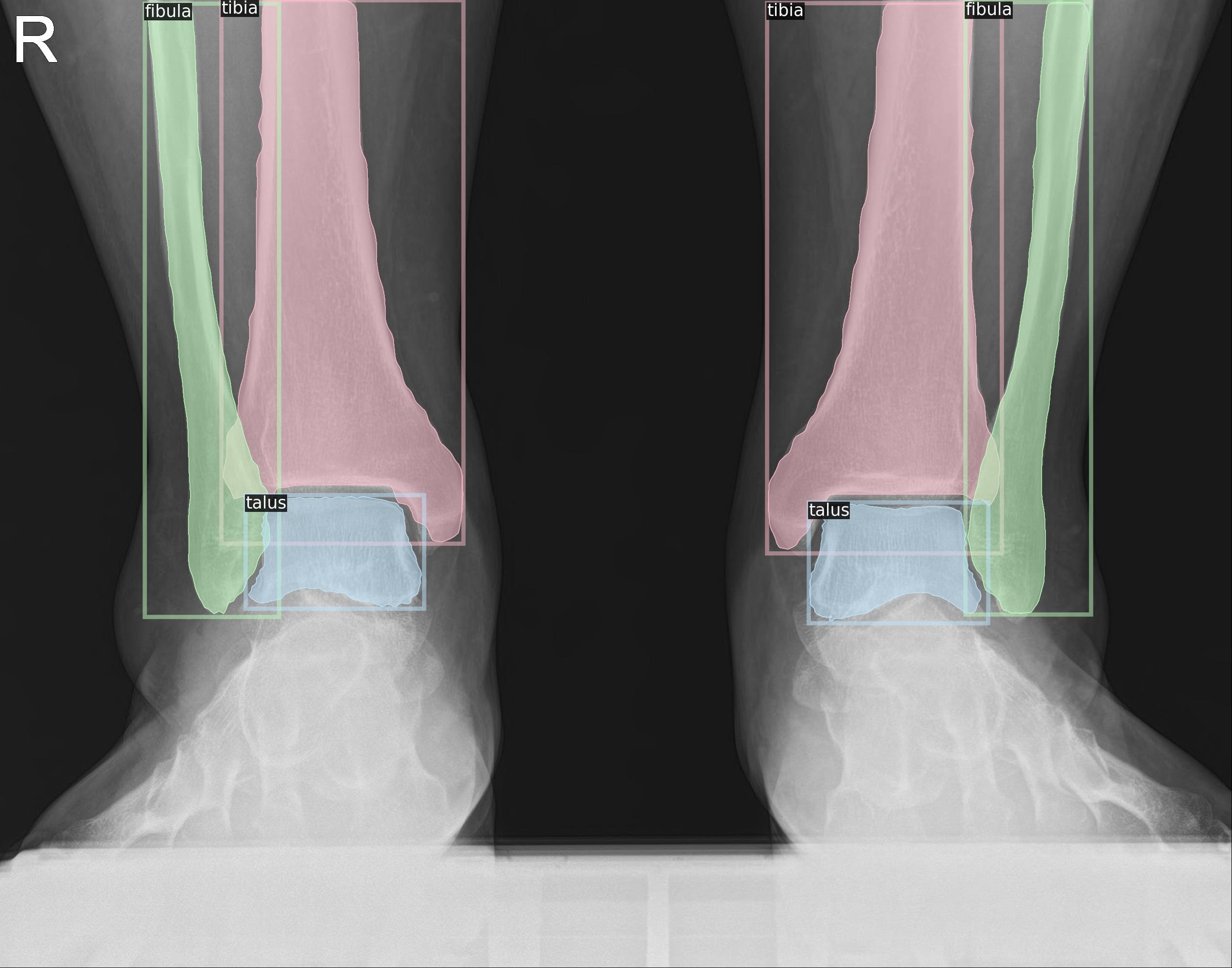 Ankle AP 결과