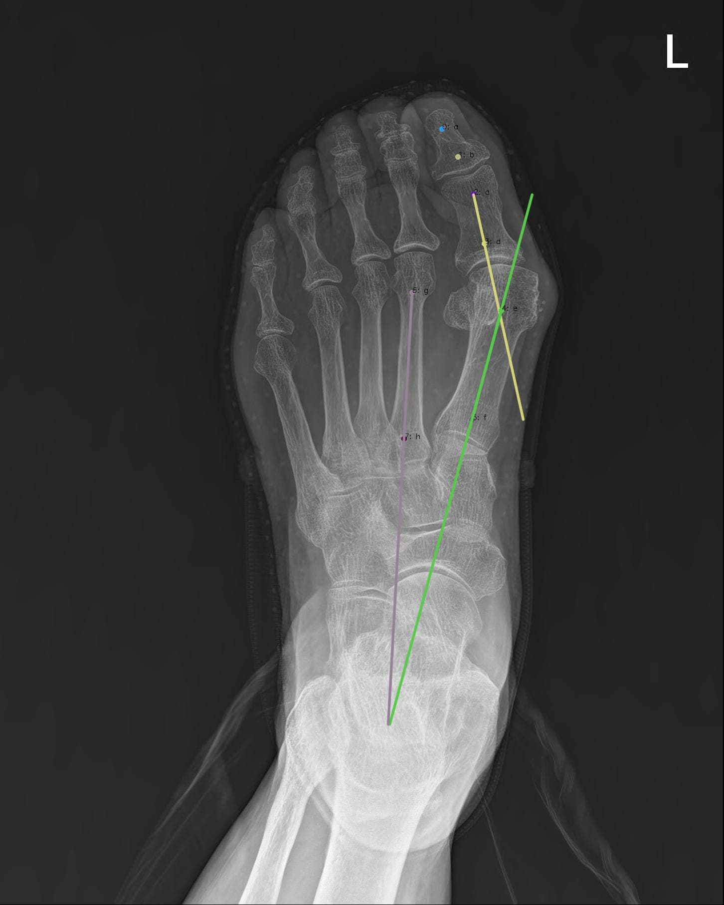 Foot AP 결과