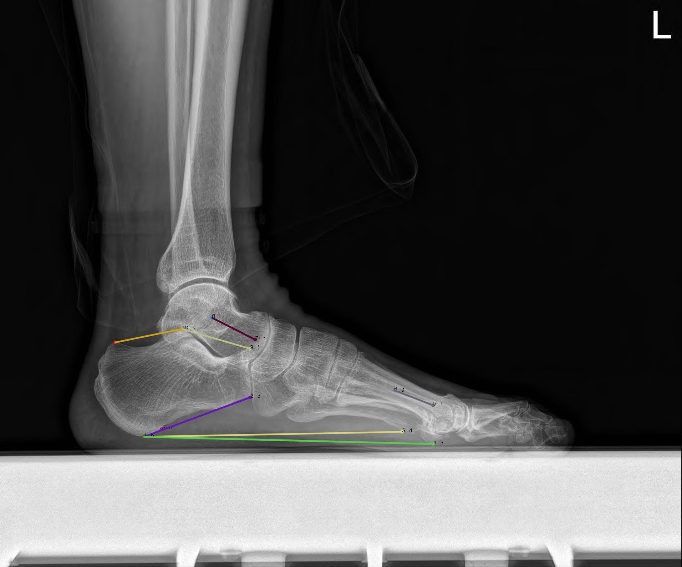 Foot LAT 결과