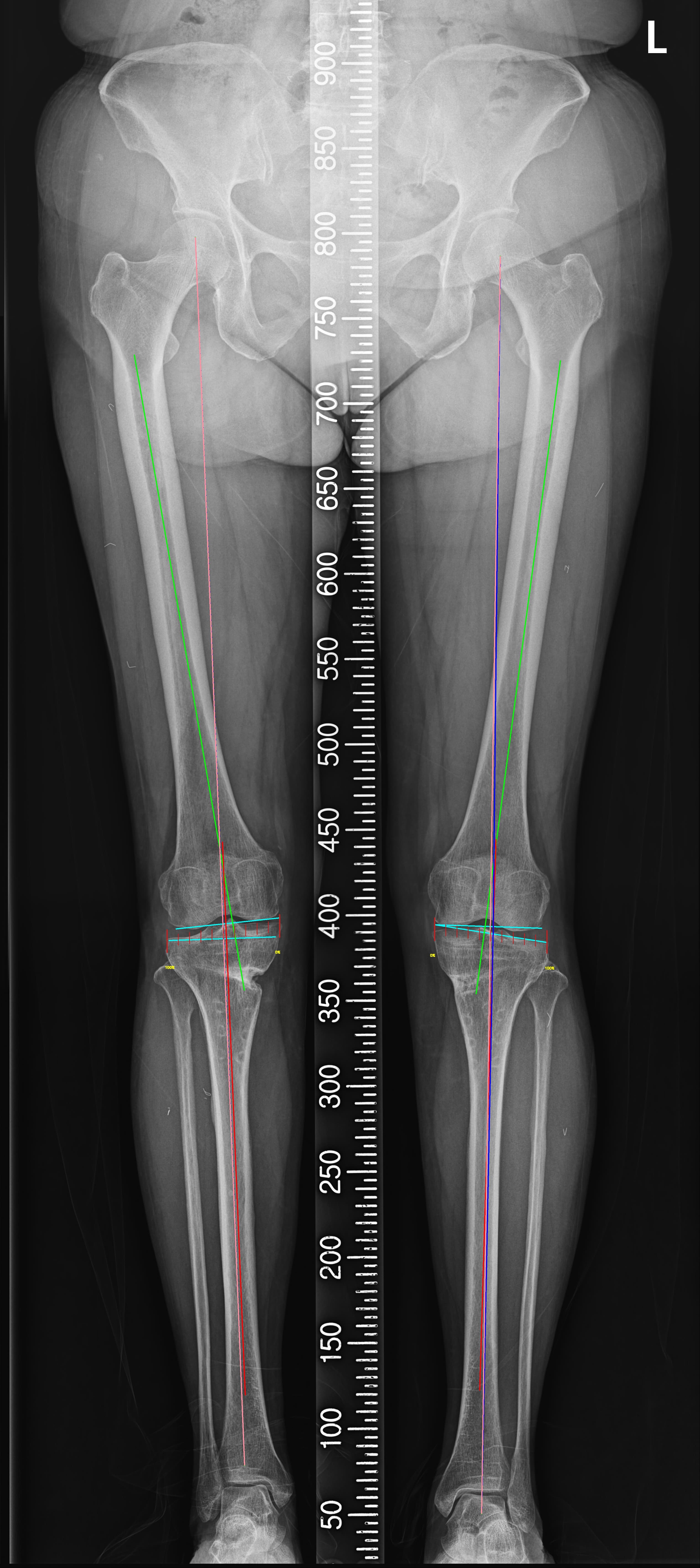 Scanogram 결과